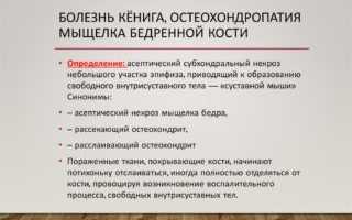 Рассекающий остеохондрит таранной кости: причины, симптомы, диагностика и профилактика