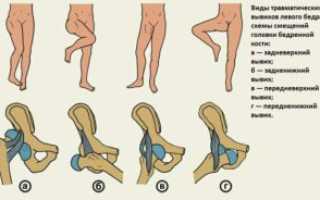 Вывих шейки бедра: причины, диагностика, первая помощь, лечение и реабилитация