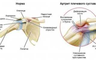 Что такое артрит левого плечевого сустава и чем его лечить