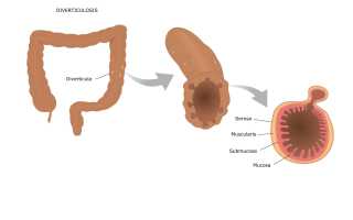 Дивертикулы кишечника у детей: почему возникают, как проявляются, принципы лечебного питания