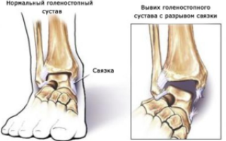 Как наложить и намотать эластичный бинт на голеностоп восьмеркой с фиксацией: фото и видео