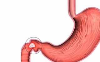 Язва 12-перстной кишки: как проявляется и лечится патология?