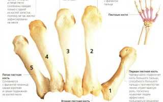 Перелом пястной кости кисти