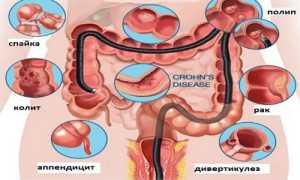 Заболевания толстого кишечника: симптомы и признаки болезни, лечение