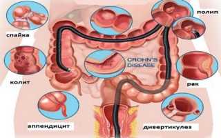 Заболевания толстого кишечника: симптомы и признаки болезни, лечение