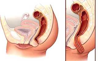 Выпадение прямой кишки: как проявляется и лечится патология?