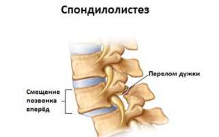 Характер болей при ущемлении седалищного нерва