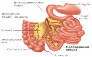 Заболевания подвздошной кишки: симптомы и признаки болезни, лечение