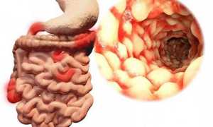 Илеит (воспаление подвздошной кишки): виды, симптомы и лечение