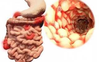 Илеит (воспаление подвздошной кишки): виды, симптомы и лечение