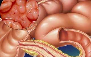 Стеноз кишечника: симптомы, лечение и прогноз для жизни