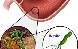 Подробно о Helicobacter pylori: диагностика и лечение возбудителя