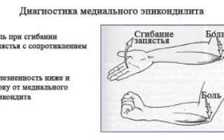 Что такое болезнь теннисиста в локтевом суставе