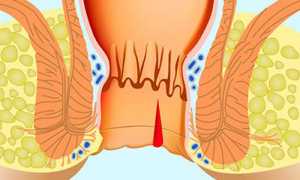 Трещина прямой кишки: причины, симптомы и лечение патологии