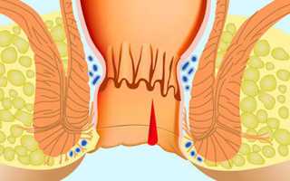 Трещина прямой кишки: причины, симптомы и лечение патологии