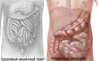 Подробно об атонии кишечника: причины, симптомы и лечение