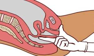 Пальцевое ректальное исследование прямой кишки