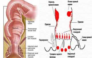Заболевания прямой кишки: симптомы и признаки болезни, лечение