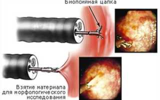 Что показывает биопсия кишечника и как проводится процедура?