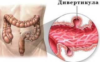 Дивертикулез кишечника: симптомы и лечение патологии