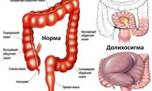 Долихосигма: что это, симптомы и тактика лечения