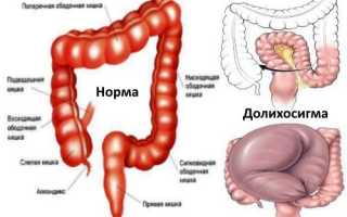 Долихосигма: что это, симптомы и тактика лечения