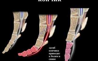 Загиб копчика: причины, к какому врачу обращаться, диагностика и осложнения