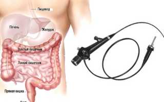 Эндоскопические методы обследования кишечника: описание и подготовка