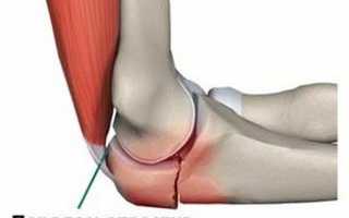 Как лечить ушиб локтевого сустава в домашних условиях