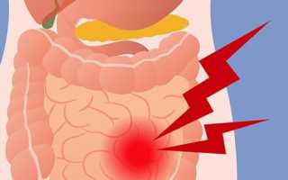Спазмы кишечника: признаки и причины патологии, методы лечения