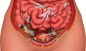 Спаечная болезнь кишечника: как проявляется и лечится?