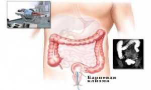 Подготовка и проведение ирригоскопии кишечника