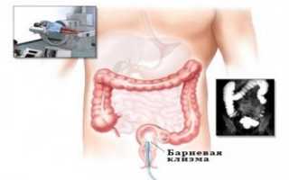 Подготовка и проведение ирригоскопии кишечника