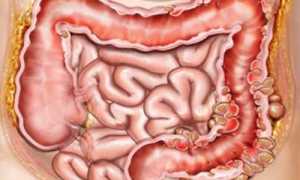 Пневматоз кишечника: что это, симптомы и методы лечения
