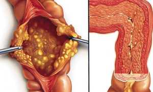 Псевдомембранозный колит: как проявляется и лечится патология?