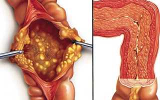 Псевдомембранозный колит: как проявляется и лечится патология?