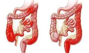 Илеоколит (воспаление подвздошной и толстой кишки): симптомы и лечение