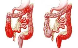 Илеоколит (воспаление подвздошной и толстой кишки): симптомы и лечение