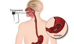 Подготовка к гастроскопии и порядок проведения процедуры