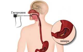 Подготовка к гастроскопии и порядок проведения процедуры