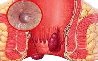 Болезни заднего прохода: признаки, диагностика и лечение патологий