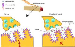 Миастения: что это такое, симптомы у детей, лечение, питание