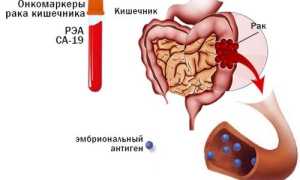 Какие онкомаркеры выявляют рак кишечника и как сдавать анализ?