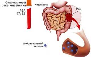 Какие онкомаркеры выявляют рак кишечника и как сдавать анализ?