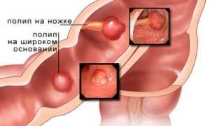 Как обнаружить и лечить полипы в кишечнике?