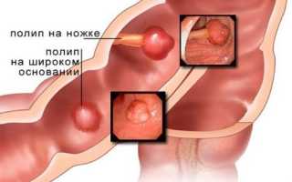 Как обнаружить и лечить полипы в кишечнике?