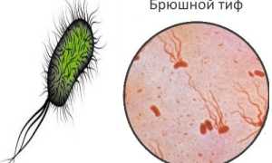 Подробно о брюшном тифе: симптомы, характеристика возбудителя, анализ и лечение