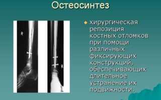 Почему умирают от перелома шейки бедра: особенности травмы и причины высокой смертности