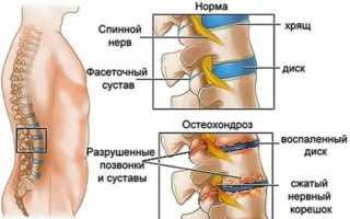 Боль в пояснице слева: причины и лечение