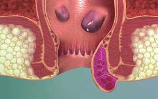 Сфинктерит прямой кишки: симптомы, методы лечения и последствия патологии